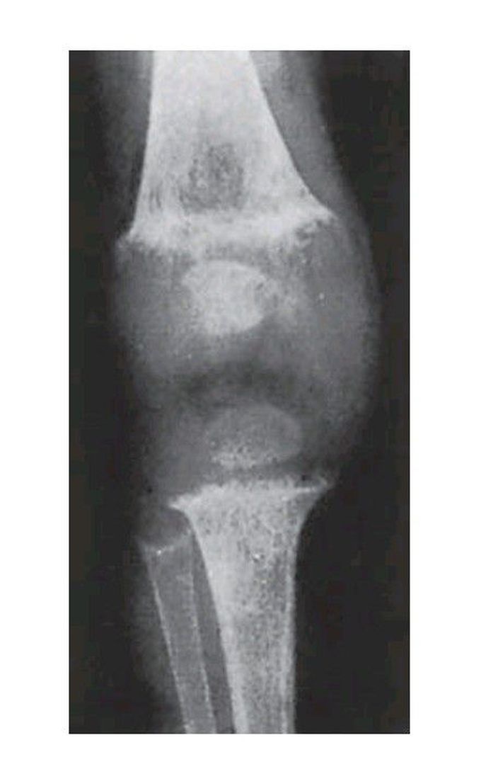 Rickets