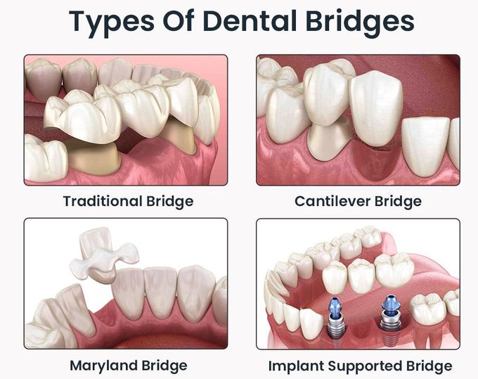 Types of Dental Bridges