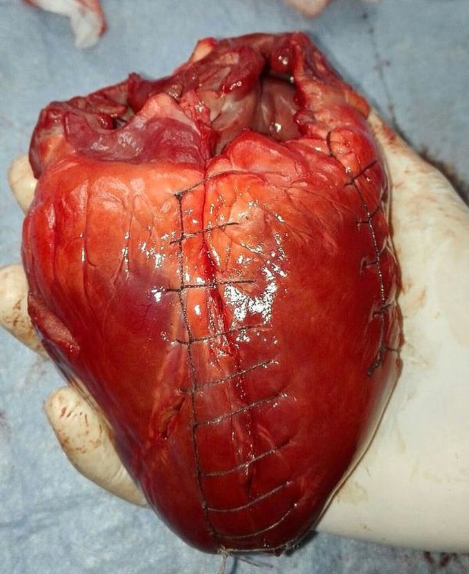 Pericardium sutures