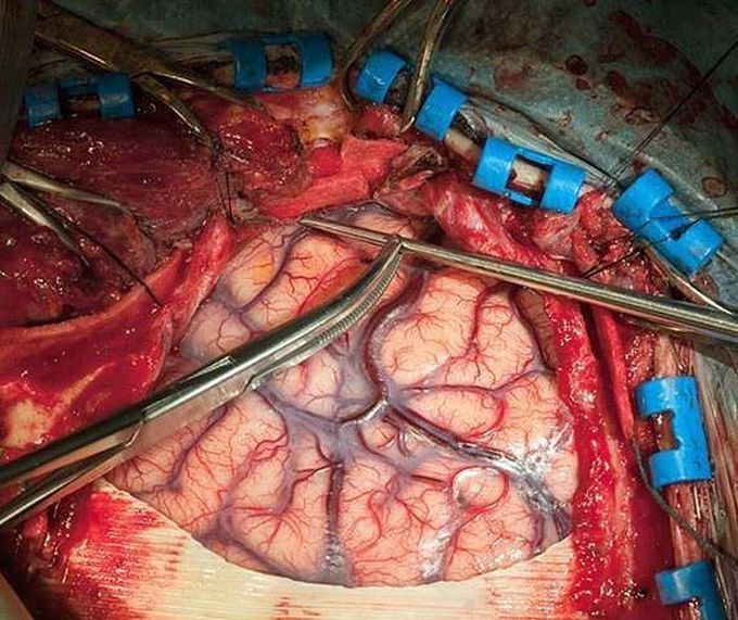 Early Complications of craniotomy