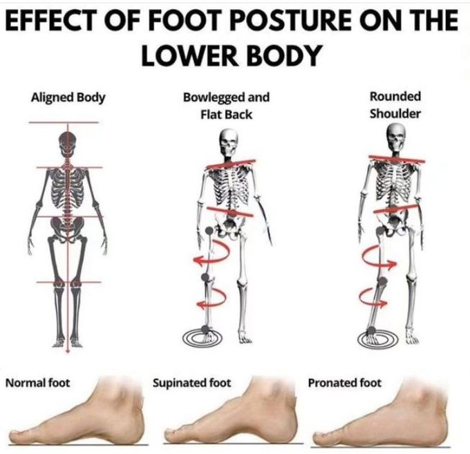 Foot Posture and Body - MEDizzy