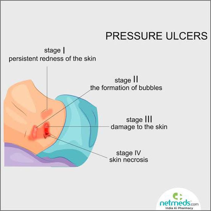 Pressure sore grades