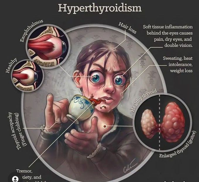 Hyperthyroidism
