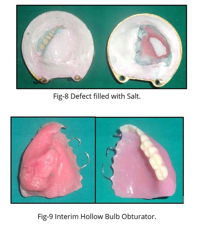 MAXILLARY HOLLOW BULB OBTURATOR