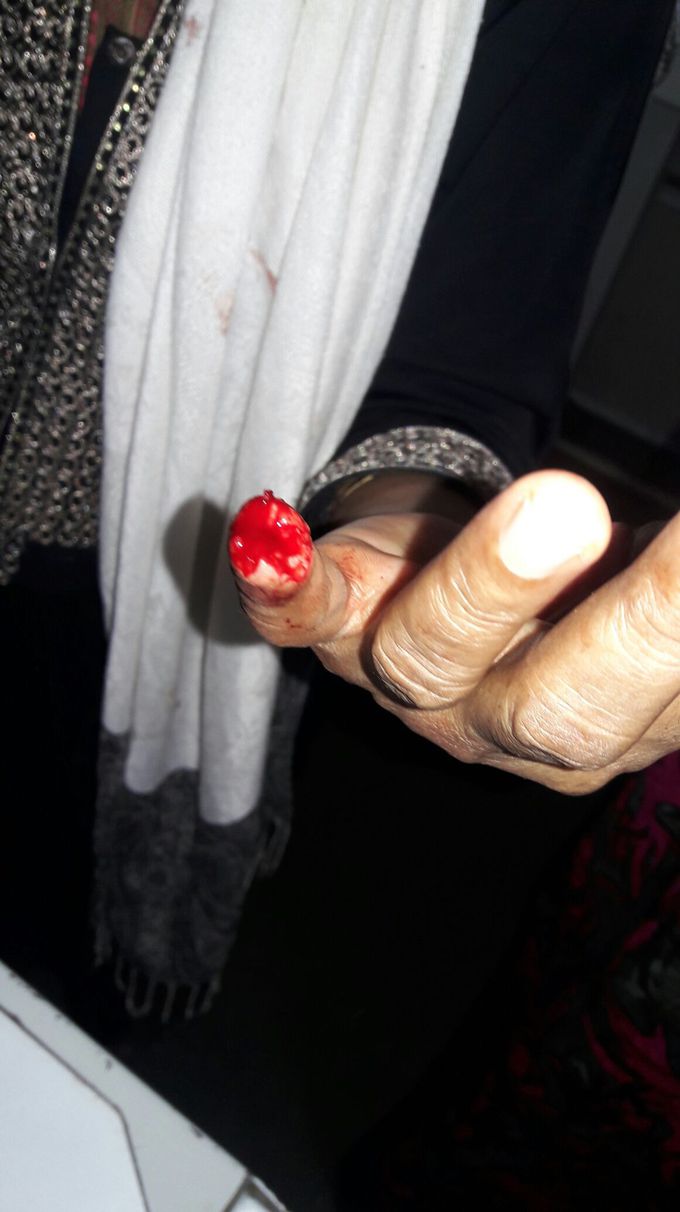 Little finger injury