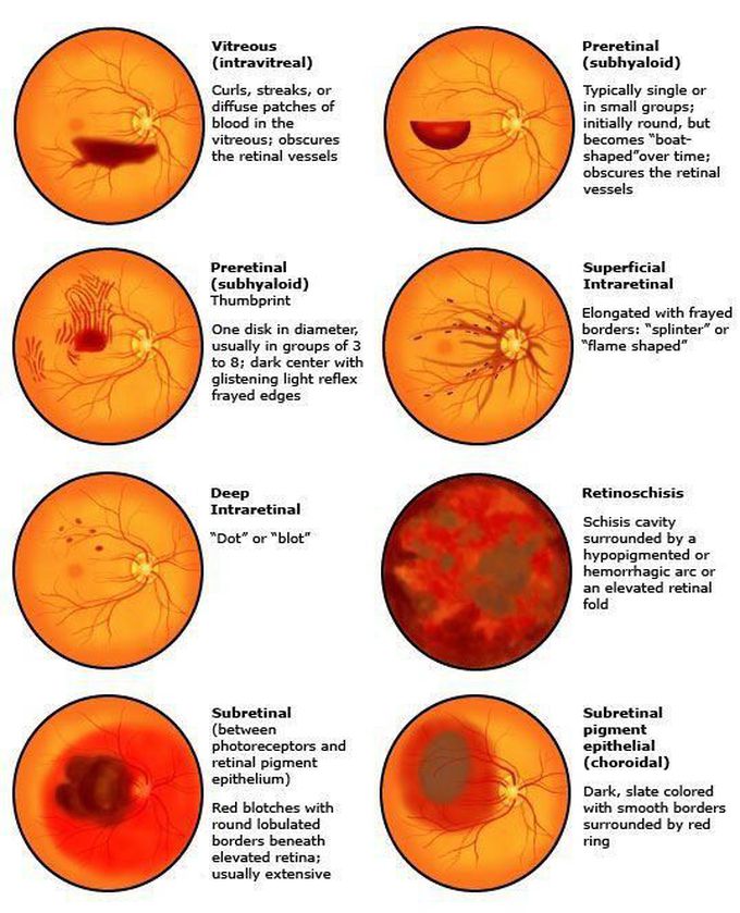 Hemorrhage types on eye fundus