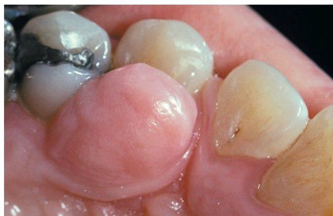 Fibroma