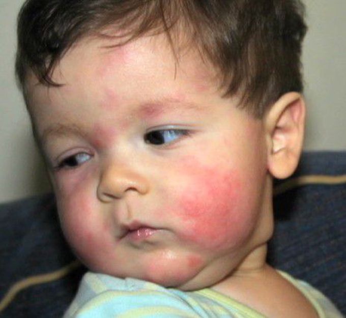 Dermatology