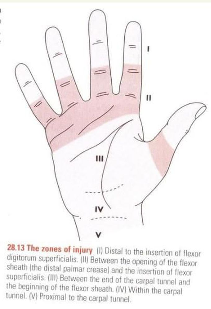 Hand Injury