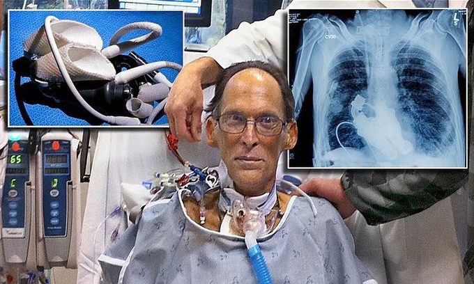 Meet the worlds first heartless human (literally) able to live without a pulse!!
