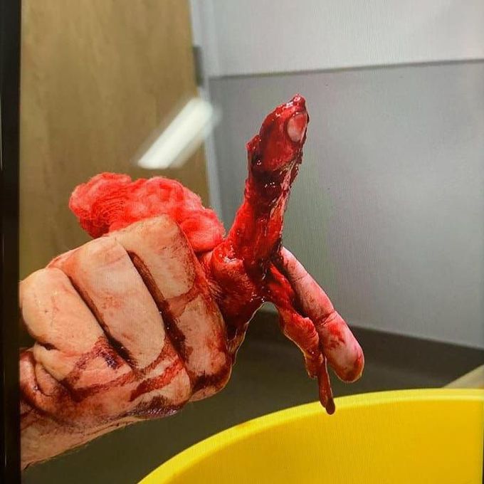 Index finger degloving injury!⚠️