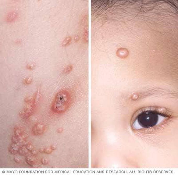 Prevention of molluscum contagiosum