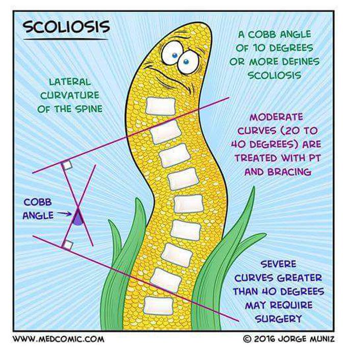 Scoliosis