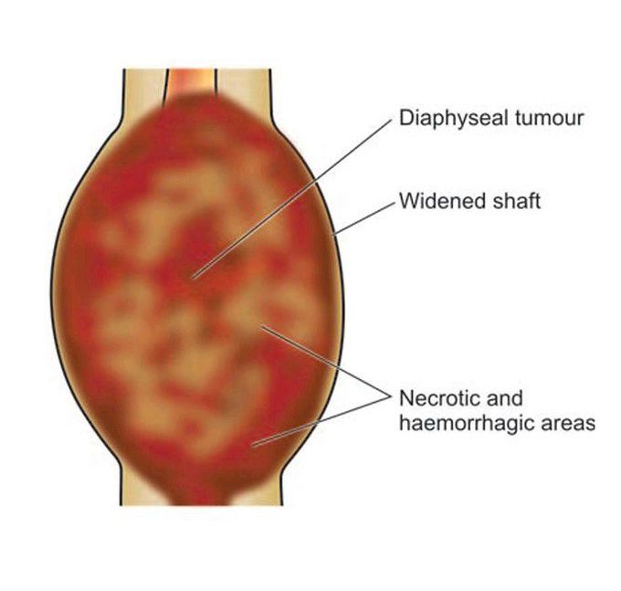 Ewing's sarcoma