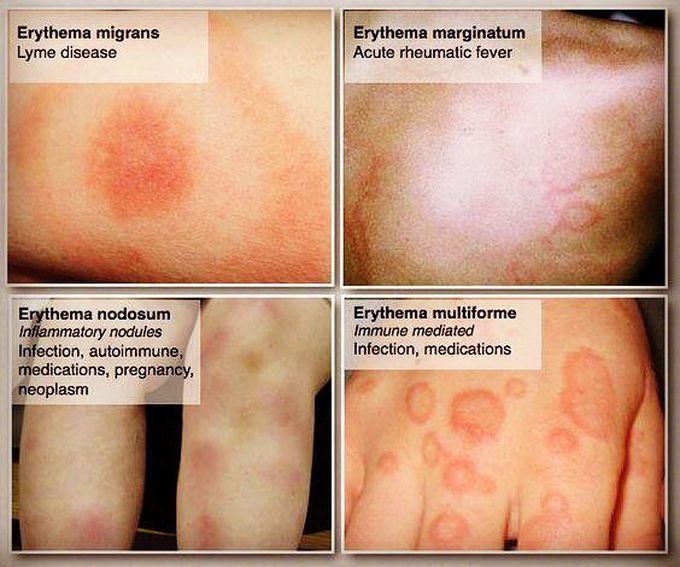 Different types of Erythema