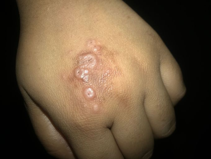 granuloma annulare