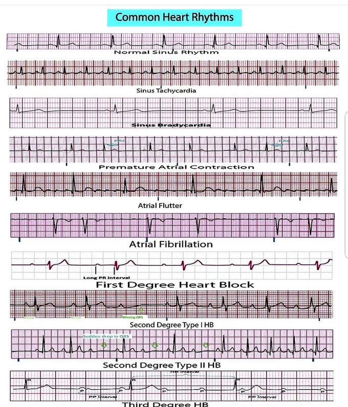 Heart rhythms