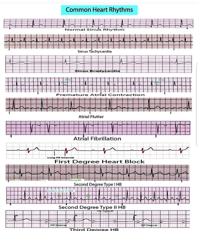Heart rhythms - MEDizzy