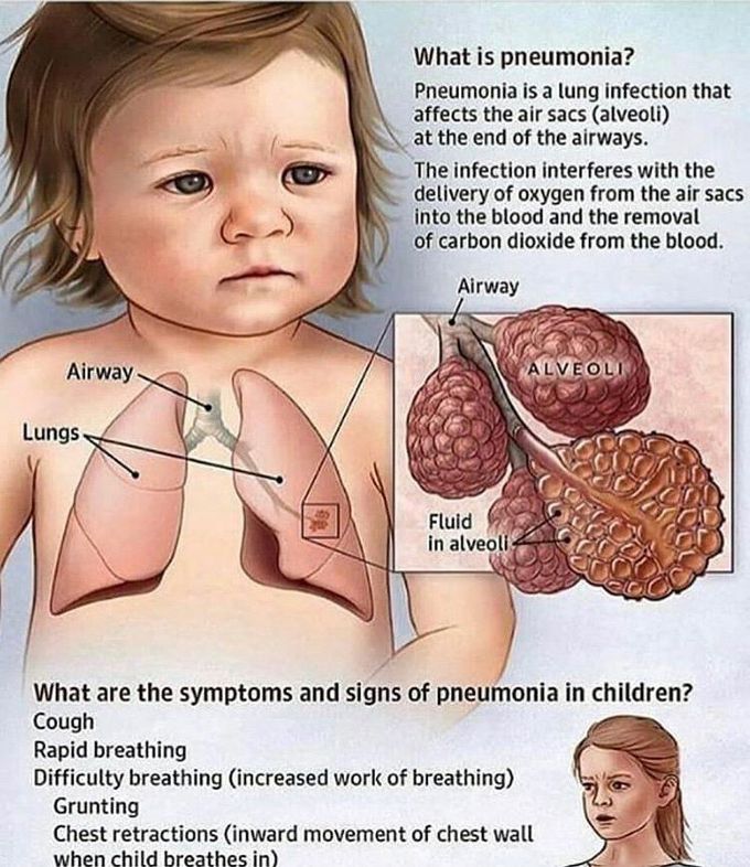 Pneumonia