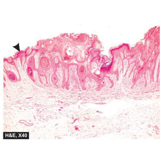 Seborrheic keratosis.