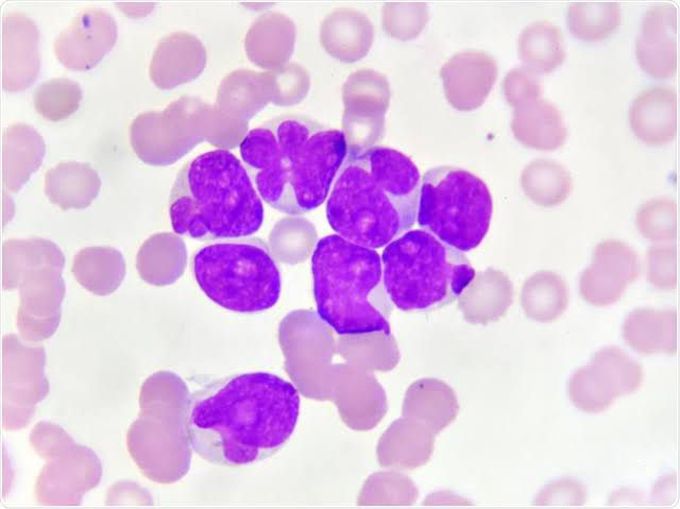 Acute myeloblastic leukemia