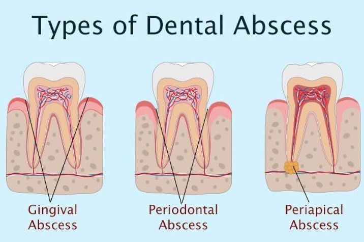 Types of dental abscess - MEDizzy