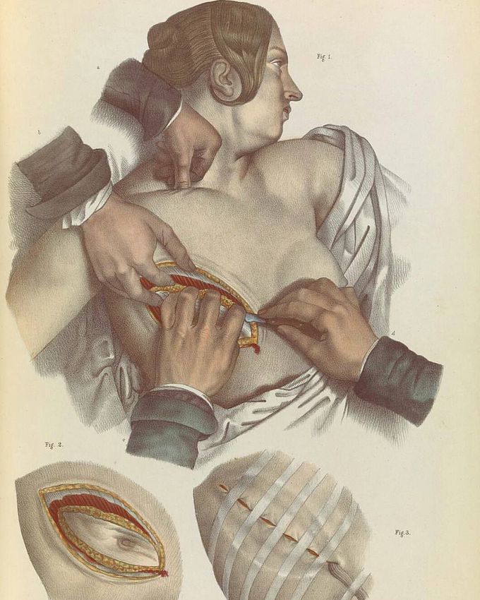 Mastectomy