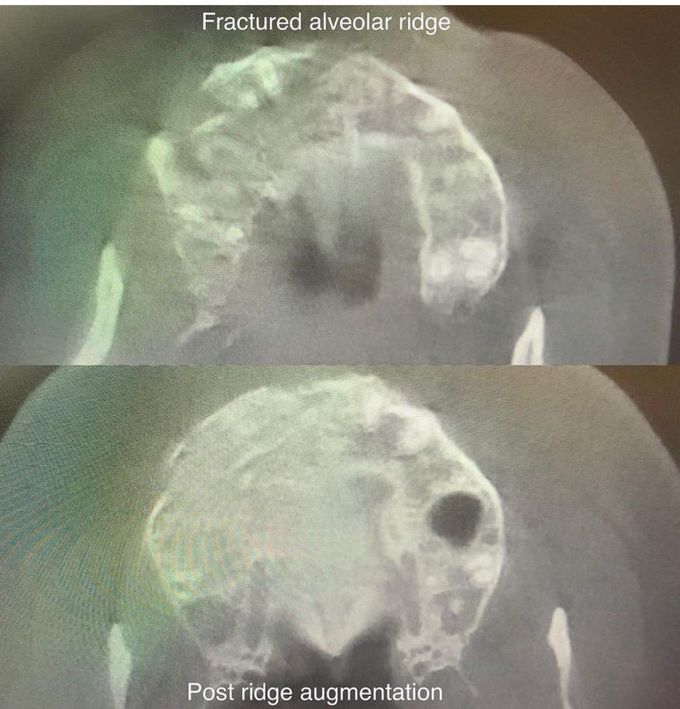 Facial Trauma