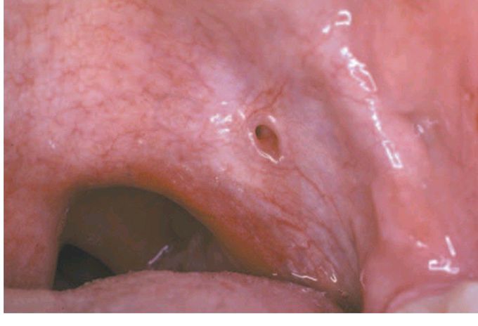 Lateral palatal fistula