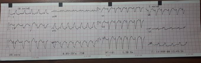 ECG with Atrial Flutter + LBBB and exstrasistole