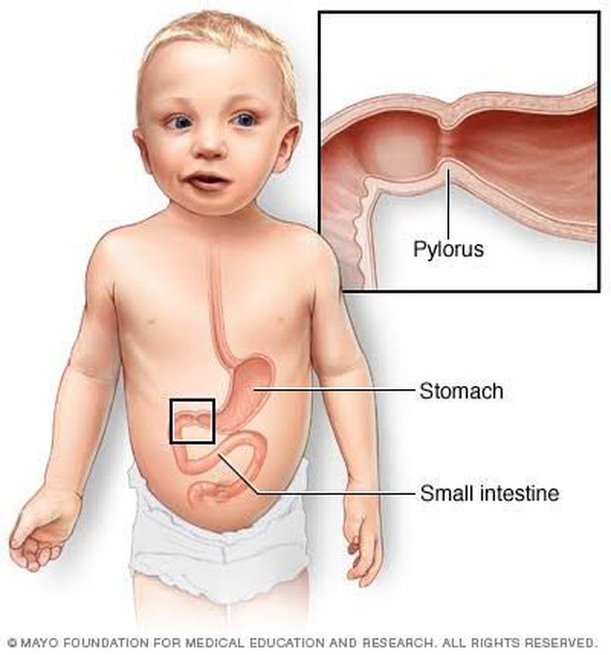 Pyloric stenosis