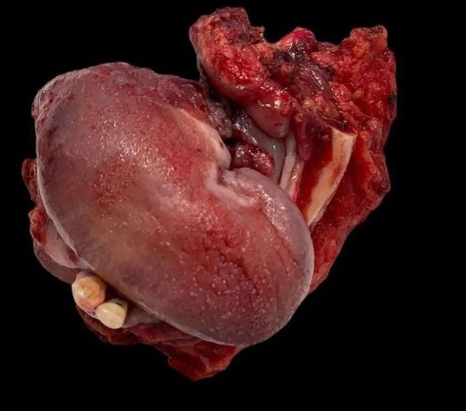 SEGMENTAL MANDIBULECTOMY- INDICATIONS