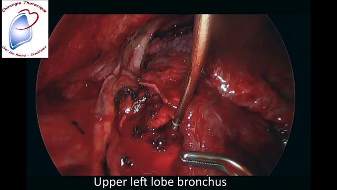 VATS Treatment for Pulmonary Aspergilloma in a Patient With Lupus