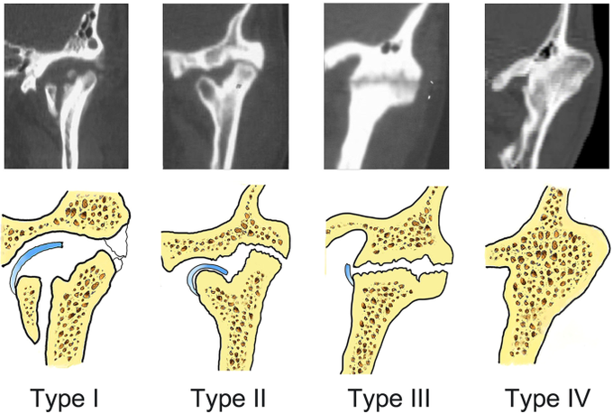 Causes of Tmj ankylosis