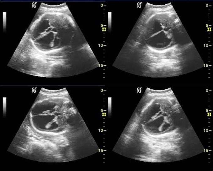 HYDROCEPHALUS