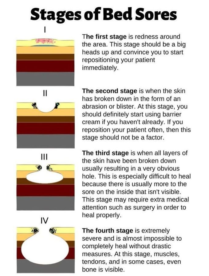 Stages of Bedsores