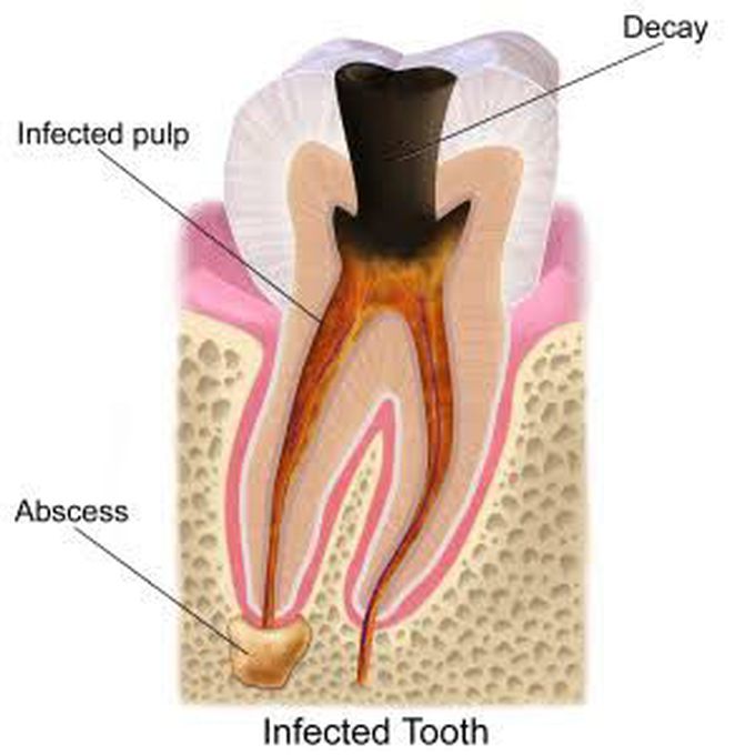 Symptoms of pulptitis