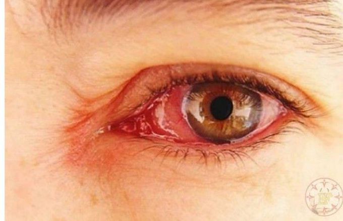 Xeropthalmia
