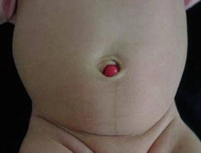That’s an Umbilical Polyp!!
