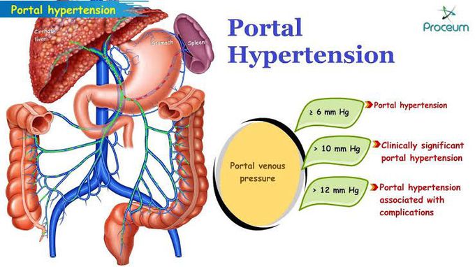 Treatment of portal hypertension