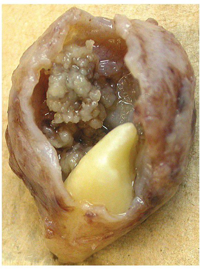 Adenomatoid Odontogenic Tumor.