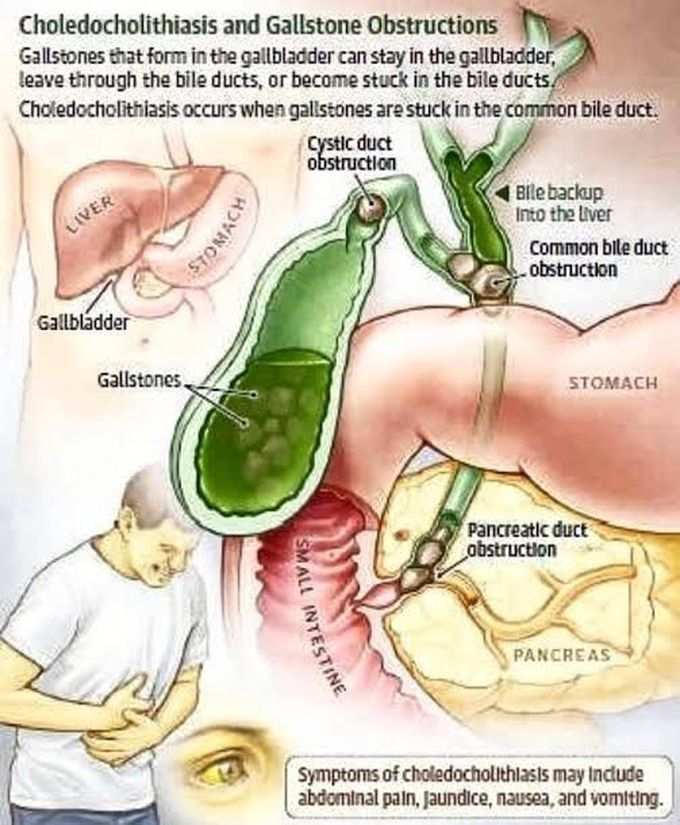 Choledocholithiasis