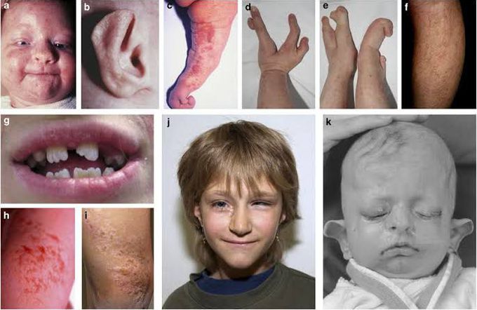 Glotz gorlin syndrome