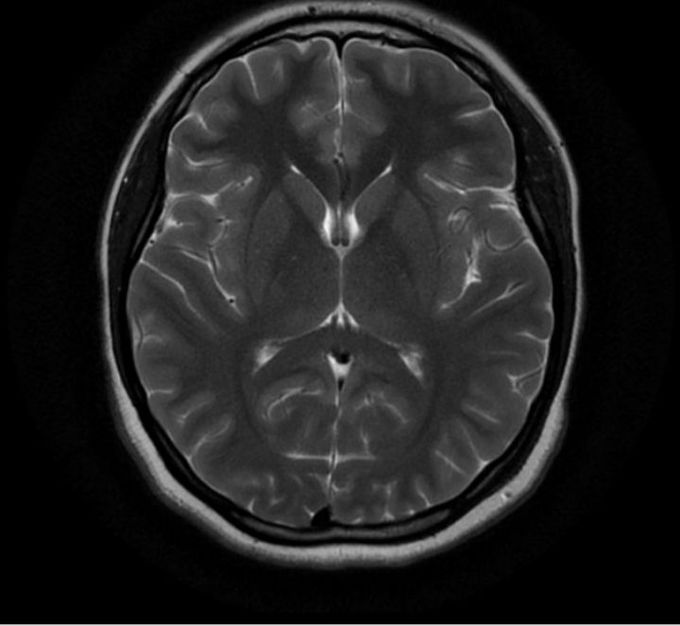 Brain