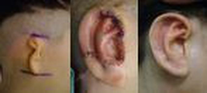Ear reconstruction surgery