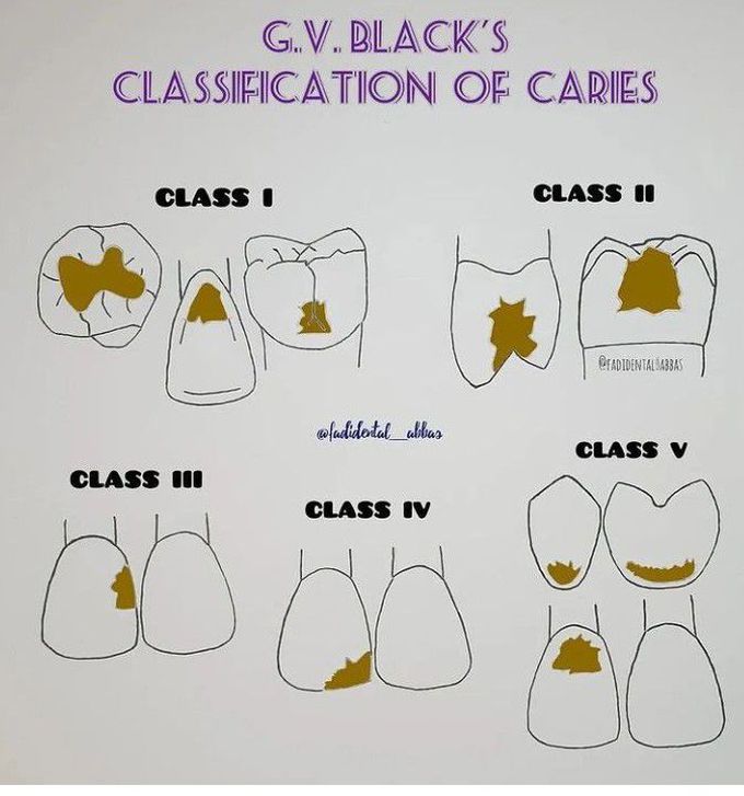 GV Black Classification of Caries