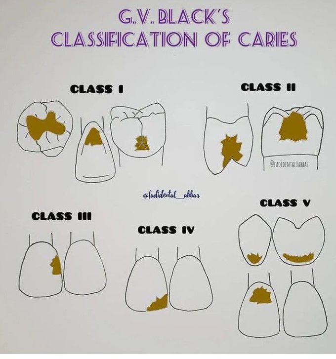 GV Black Classification of Caries - MEDizzy