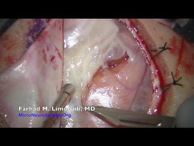 Brain Surgery : Resection of brain mass found to be AVM (Arterio Venous Malformation)
