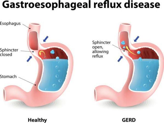 Gastroesophageal Reflux Disease (Gerd
