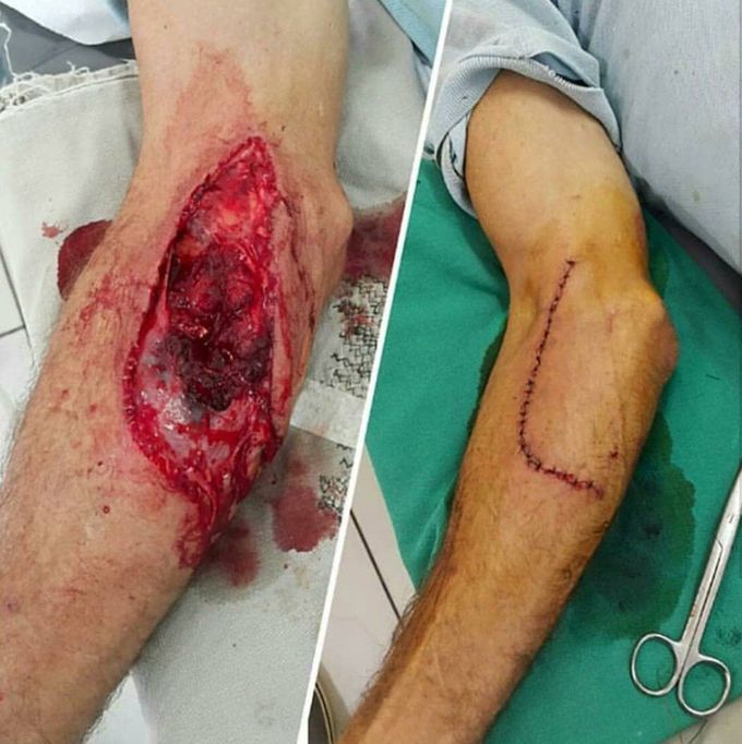 Sutures